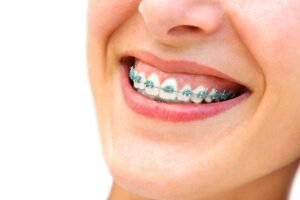 good braces colors