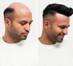 Hair Transplant