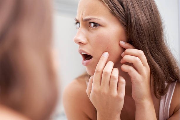 Get Rid of Acne as Quickly as Possible